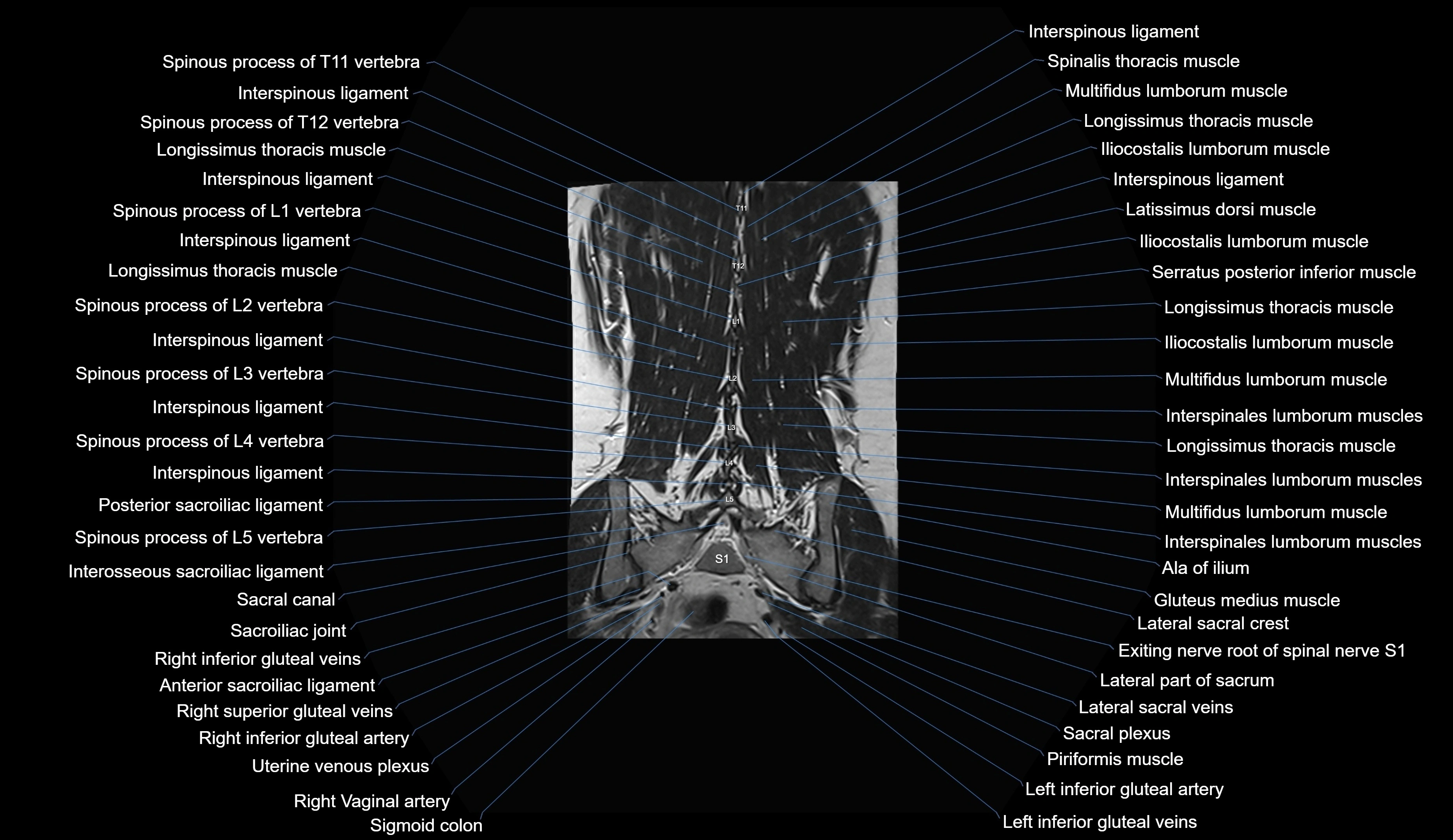 MRI lumbar spine coronal cross sectional anatomy 3T radiology  image-img-00001-00028.webp